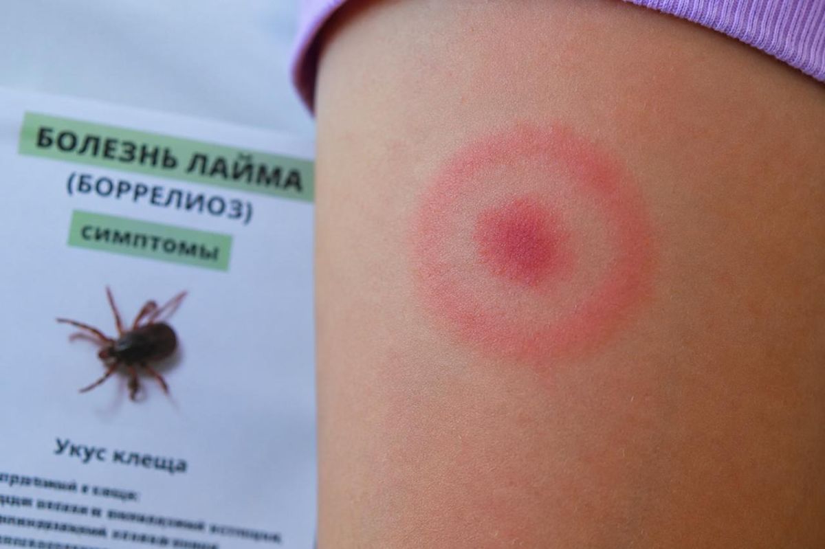 В Измаиле у ребенка подтвердили болезнь Лайма после укуса клеща